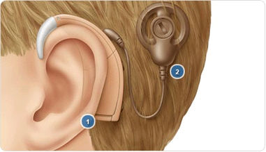 an image of the external portion of the cochlear implant.